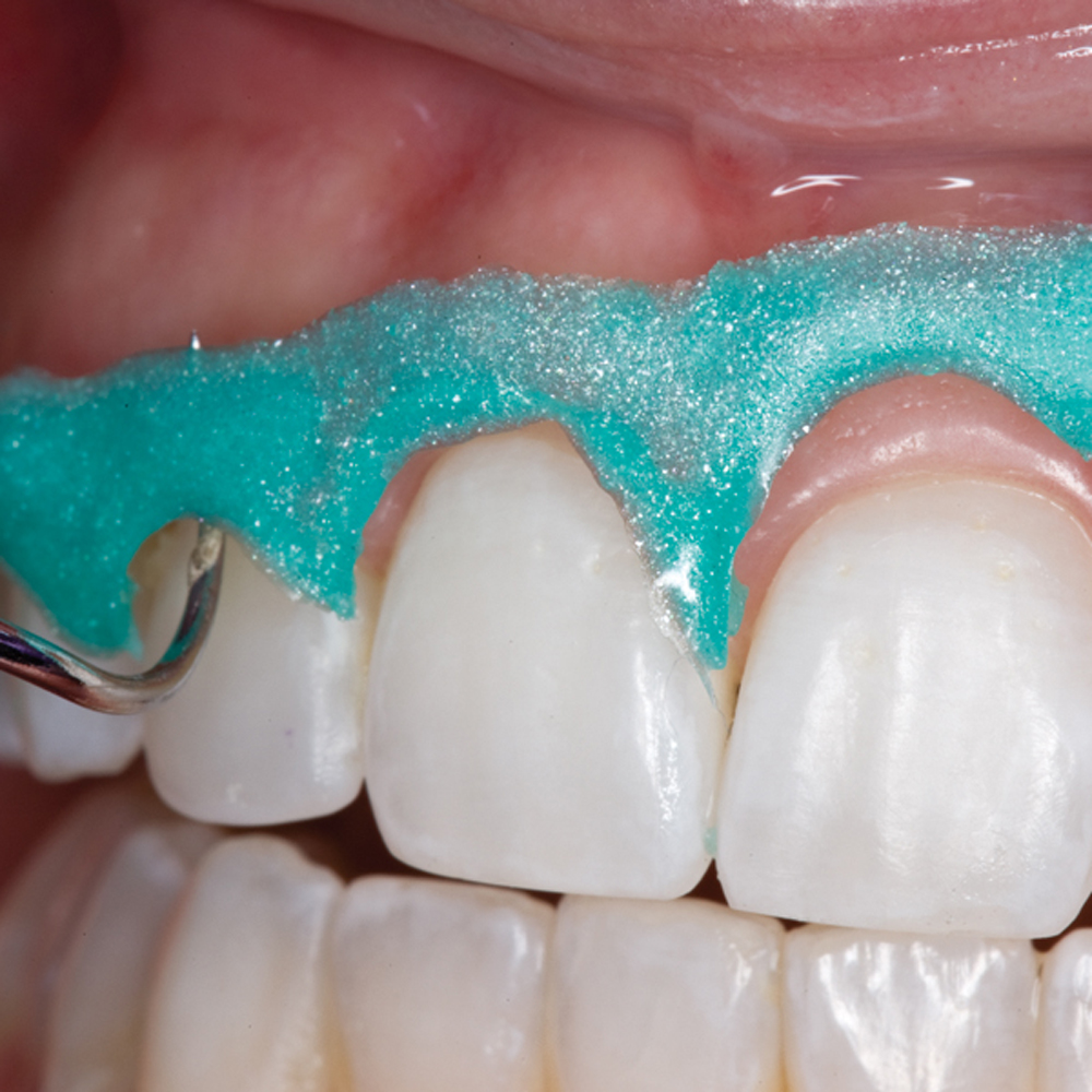 Покрытие фтором. Аппликационная анестезия в стоматологии. Каппа: реминерализирующая. Каппы для реминерализующей терапии.
