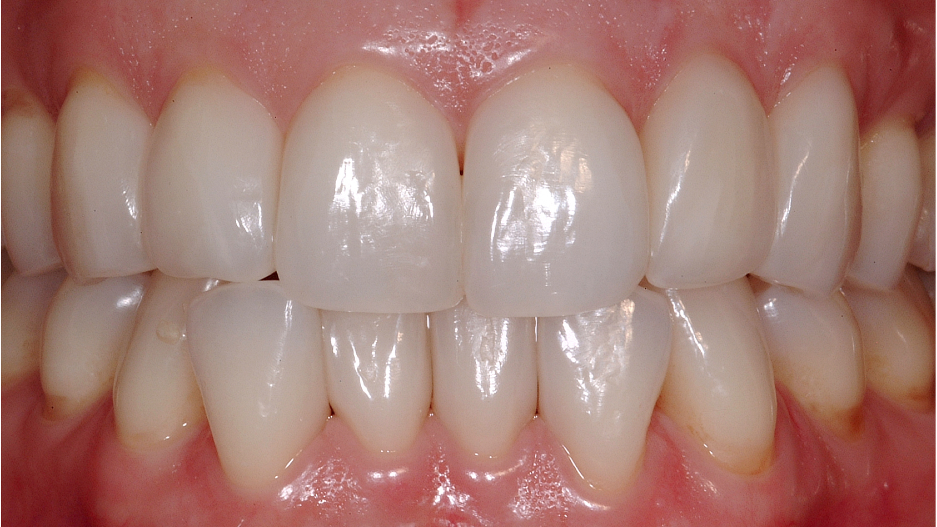 1. Bioclear Matrix After 1 Optident Specialist Dental Products And