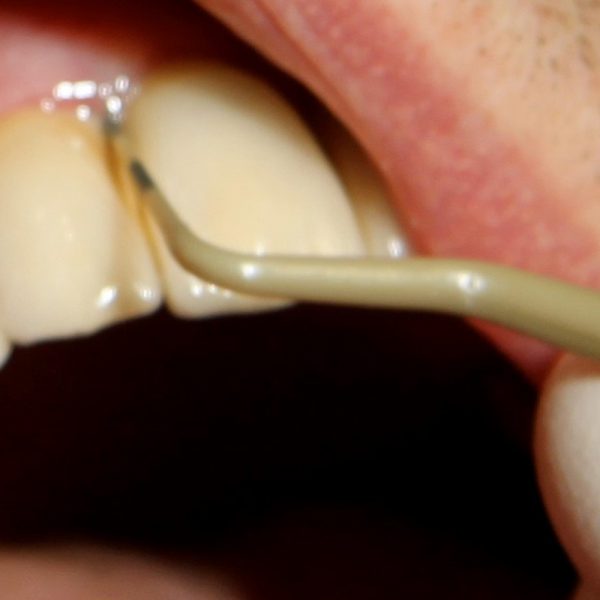 Teeth whitening products in sa