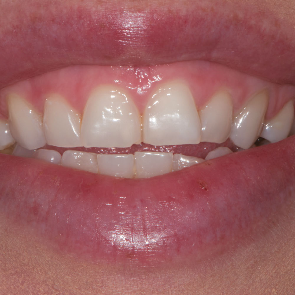 Dental Laser Before - Optident