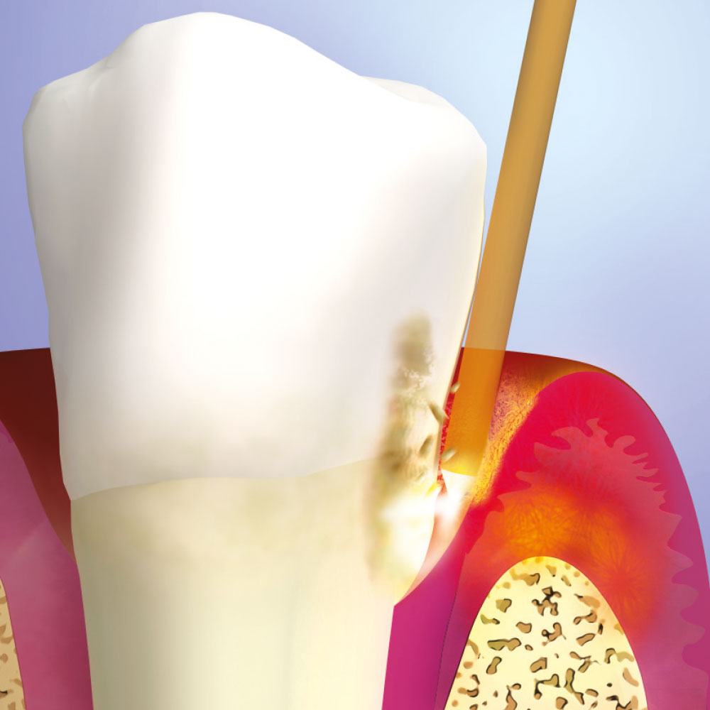 How a Dental Laser can work - Optident