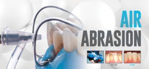 Air Abrasion Header Image - Optident