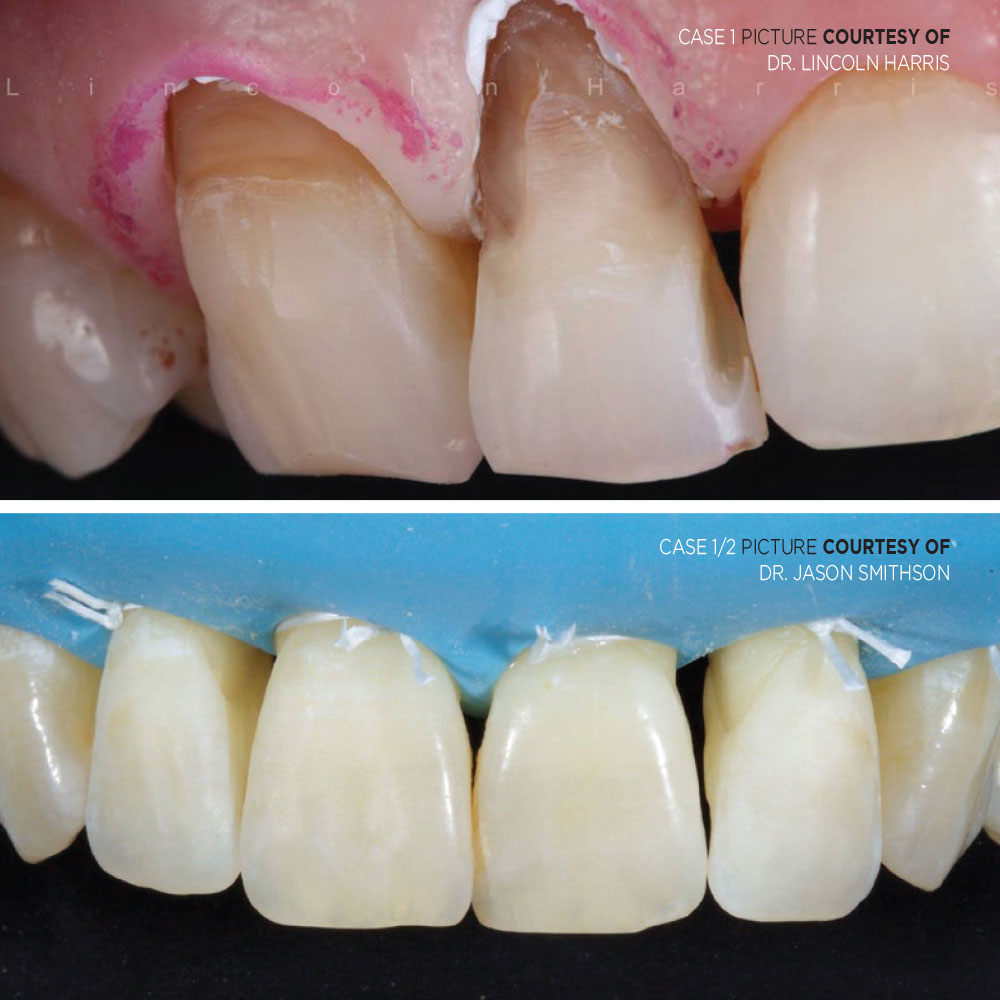 Air Abrasion Case 1 - Optident