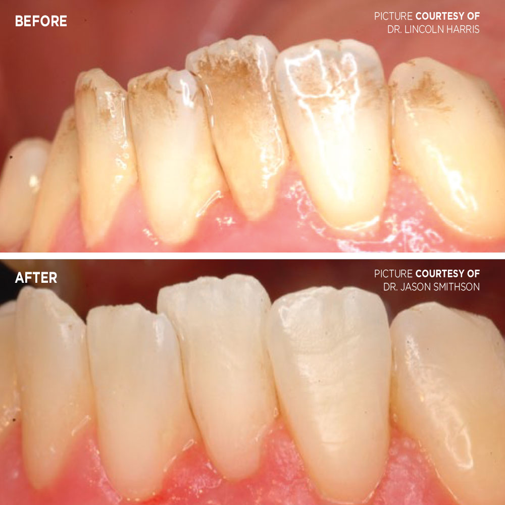 Cleaning with air abrasion case - Optident