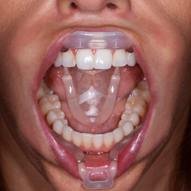 Umbrella Retractor Medium 5pk Optident Specialist Dental Products