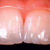 ENAMEL PLUS HFO Dentine Syringe UD2 - Optident Ltd