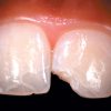 ENAMEL PLUS HFO Dentine Syringe UD3 - Optident Ltd