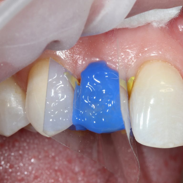 UltraEtch 35 Econo Kit Optident Specialist Dental Products And