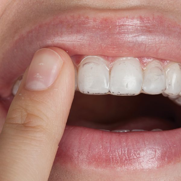 Opalescence PF 10 Regular Patient Kit Optident Specialist Dental