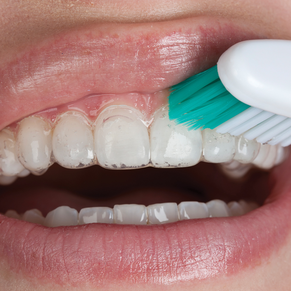 opalescence отбеливание зубов у стоматолога
