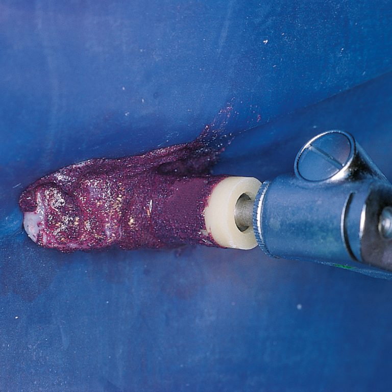 Opalustre Kit Optident Specialist Dental Products And Courses