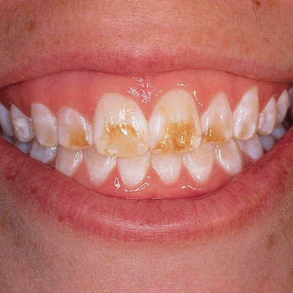 Opalustre Kit Optident Specialist Dental Products And Courses