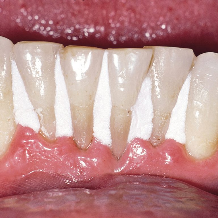 Oraseal Caulking and Putty Kit Optident Specialist Dental Products