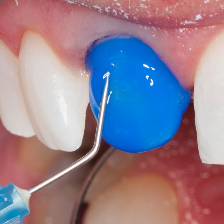 UltraEtch 35 Kit Optident Specialist Dental Products And Courses