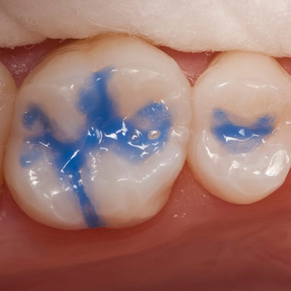 UltraEtch 35 Kit Optident Specialist Dental Products And Courses