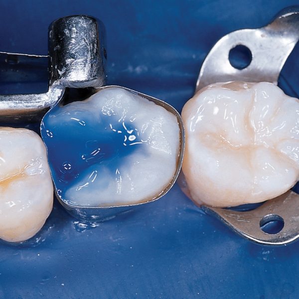 UltraEtch 35 Kit Optident Specialist Dental Products And Courses