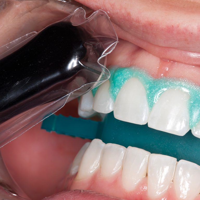 Opalescence Office Patient Kit - Optident - Specialist ...