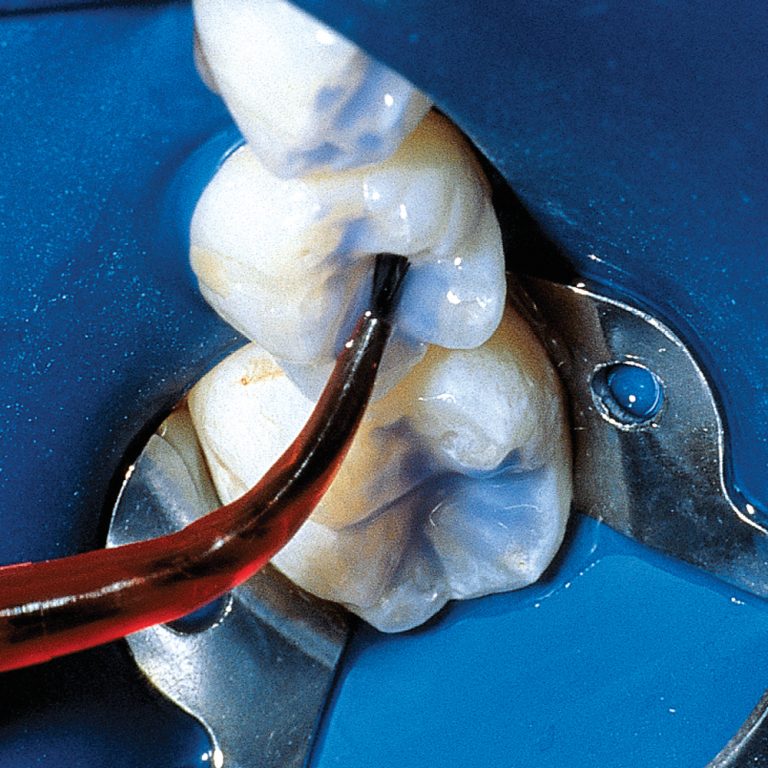 UltraSeal XT Plus Opaque White Optident Specialist Dental Products And Courses