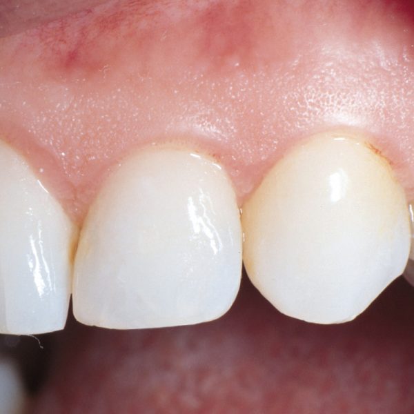 Permaseal Composite Sealer Optident Specialist Dental Products And