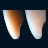 ENAMEL PLUS HFO Dentine Tips UD4 - Optident Ltd