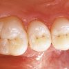 ENAMEL PLUS HFO Dentine Tips UD4 - Optident Ltd