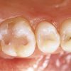 ENAMEL PLUS HFO Dentine Syringe B1 - Optidnt Ltd