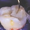 Ribbond THM Refill 3mm - Image 4
