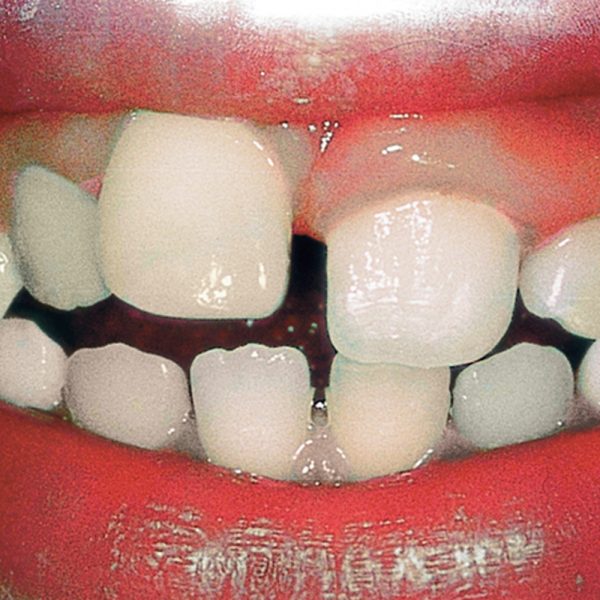 Ceramic Tissue Trimmer Optident Specialist Dental Products And Courses