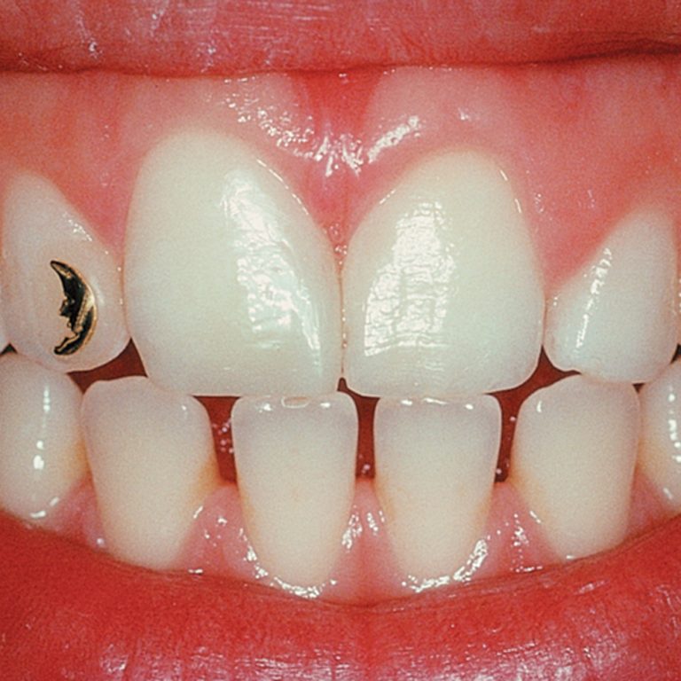 Ceramic Tissue Trimmer Optident Specialist Dental Products And Courses