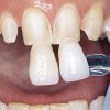 Permaflo Dentine Opaquer - Optident Ltd