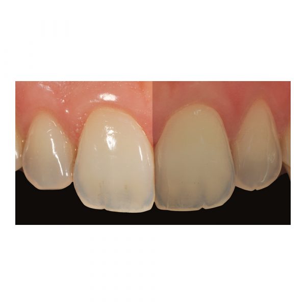 Smile Lite Complete - Optident - Specialist Dental ...